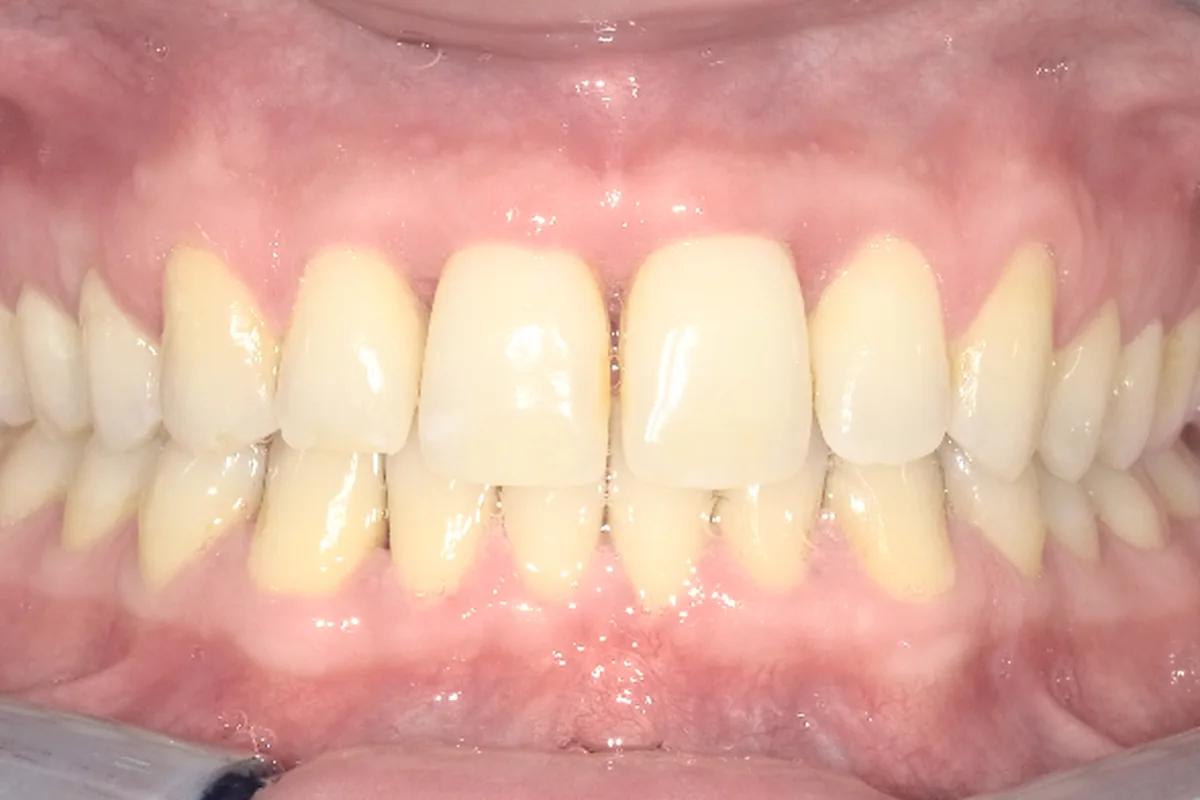 After: calmer, healthier gum tissue following non-surgical periodontal therapy at Poulos, Somers & Marshall, Denver