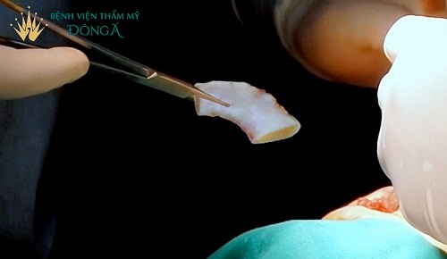 Nâng mũi điêu khắc – Cái tên mới nhưng vẫn thiếu 4 Ưu điểm sau - Hình 4
