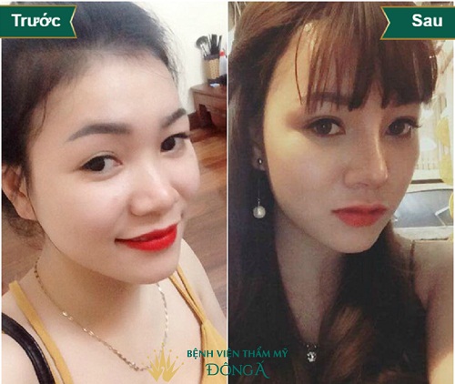 Nâng mũi bọc sụn vành tai - Dễ dàng tương thích với cơ thể