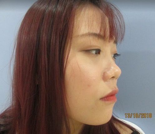 Một trong những trường hợp điển hình nên thực hiện nâng mũi bọc sụn vành tai
