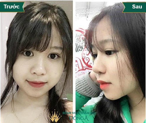 Nâng mũi bọc sụn vành tai – Duy trì được kết quả lâu dài với thời gian