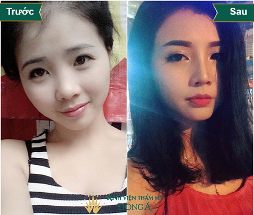 Nâng mũi bọc sụn vành tai – Phương pháp nâng mũi Model 2D bọc sụn mang đến dáng mũi sang chảnh, quý phái