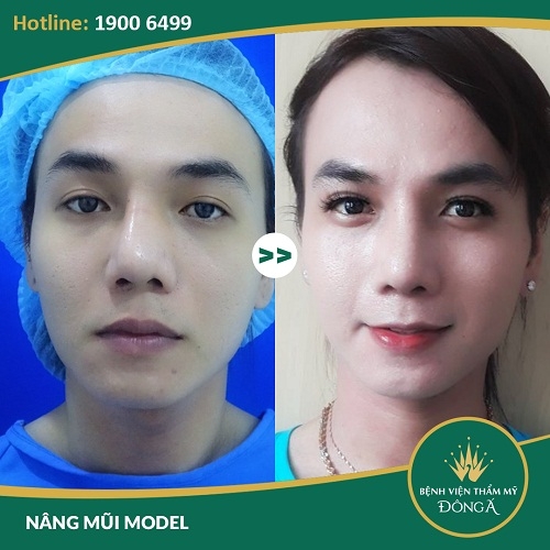 Cách nhận biết mũi bị lệch và 4 TIP khắc phục mũi lệch Tốt Nhất - Hình 7