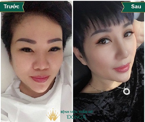 Mũi cao là gì ? Dáng Mũi Cao Đẹp trong Tướng Số và Thẩm Mỹ - Hình 5