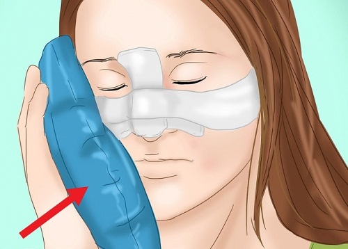Nâng mũi bọc sụn có vĩnh viễn không ? 4 Cách giữ mũi Mãi Đẹp - Hình 4