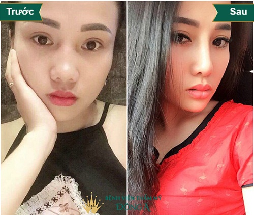 Nâng mũi SLine 4D giá bao nhiêu tiền ? Cập nhật Bảng Giá 2019 - Hình 1