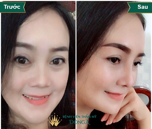Nâng mũi SLine 4D giá bao nhiêu tiền ? Cập nhật Bảng Giá 2019 - Hình 3