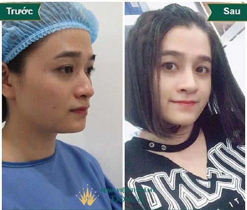 Nâng mũi SLine 4D giá bao nhiêu tiền ? Cập nhật Bảng Giá 2019 - Hình 2