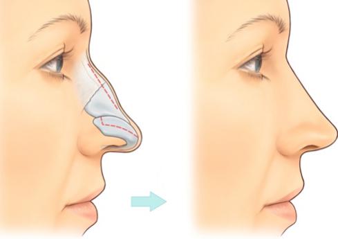 [Bật Mí] 2 Phương pháp nâng mũi gồ Siêu Hiệu Quả cho mũi đẹp -Ảnh 1