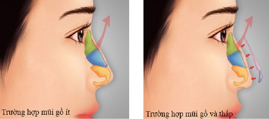 [Bật Mí] 2 Phương pháp nâng mũi gồ Siêu Hiệu Quả cho mũi đẹp -Ảnh 2