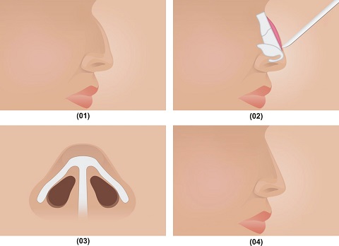 [Bật Mí] 2 Phương pháp nâng mũi gồ Siêu Hiệu Quả cho mũi đẹp -Ảnh 3