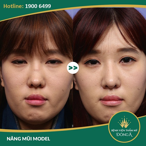 [Bật Mí] 2 Phương pháp nâng mũi gồ Siêu Hiệu Quả cho mũi đẹp -Ảnh 6