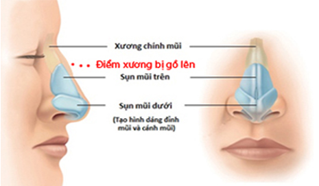 [Bật Mí] 2 Phương pháp nâng mũi gồ Siêu Hiệu Quả cho mũi đẹp -Ảnh 4