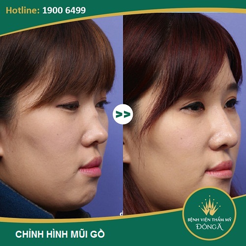 [Bật Mí] 2 Phương pháp nâng mũi gồ Siêu Hiệu Quả cho mũi đẹp-Ảnh 5