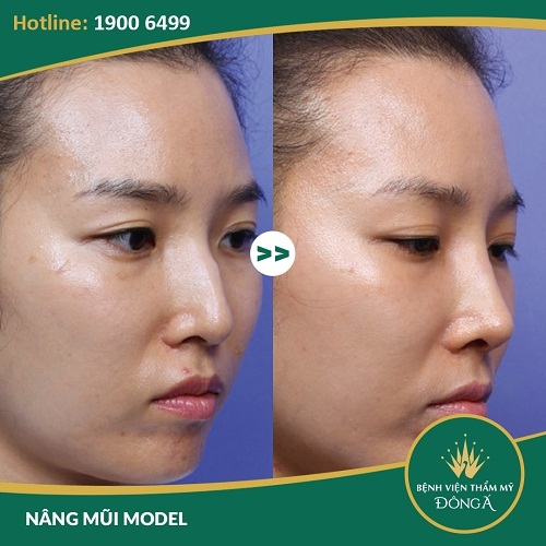 [Bật Mí] 2 Phương pháp nâng mũi gồ Siêu Hiệu Quả cho mũi đẹp -Ảnh 7
