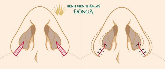 Cắt cánh mũi có nguy hiểm không? Liệu có được thon gọn vĩnh viễn? - Hình 2