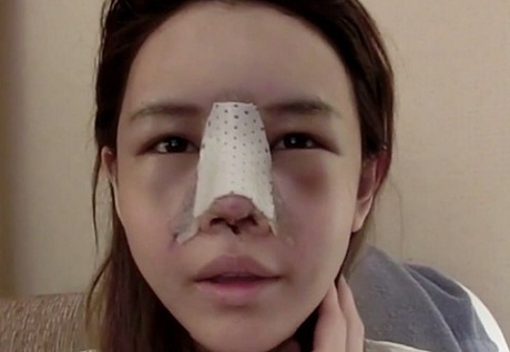 Nâng mũi bao lâu thì lành ? 3 Cách giúp mũi bạn Hồi Phục Nhanh hơn - Hình 4