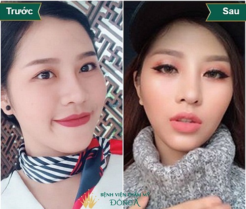 Nâng mũi điêu khắc – Cái tên mới nhưng vẫn thiếu 4 Ưu điểm sau - Hình 5