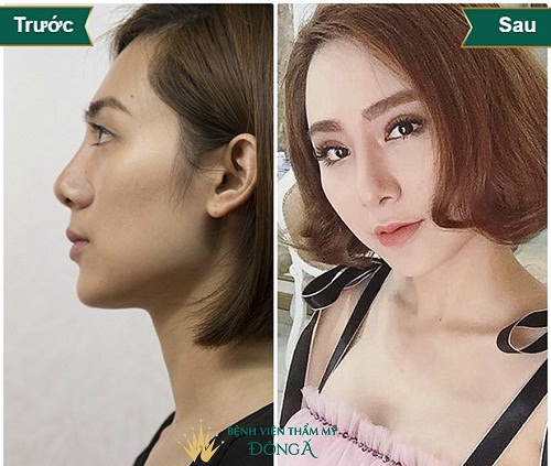 Nâng mũi điêu khắc – Cái tên mới nhưng vẫn thiếu 4 Ưu điểm sau - Hình 8