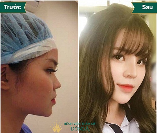 Nâng mũi điêu khắc – Cái tên mới nhưng vẫn thiếu 4 Ưu điểm sau - Hình 6
