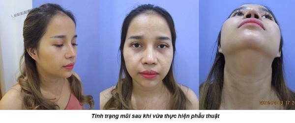 Đầu mũi to sau khi nâng | Nguyên Nhân & 5 Cách Khắc Phục Chuẩn - Hình 5