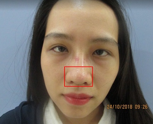 Đầu mũi to sau khi nâng | Nguyên Nhân & 5 Cách Khắc Phục Chuẩn - Hình 1