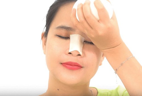 Đầu mũi to sau khi nâng | Nguyên Nhân & 5 Cách Khắc Phục Chuẩn - Hình 4