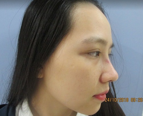 Đầu mũi to sau khi nâng | Nguyên Nhân & 5 Cách Khắc Phục Chuẩn - Hình 2
