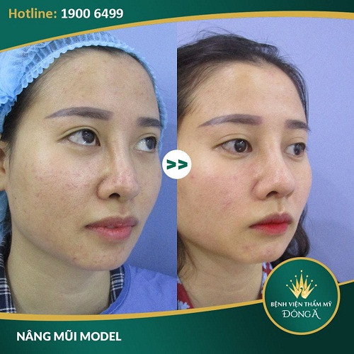 Đầu mũi to sau khi nâng | Nguyên Nhân & 5 Cách Khắc Phục Chuẩn - Hình 6