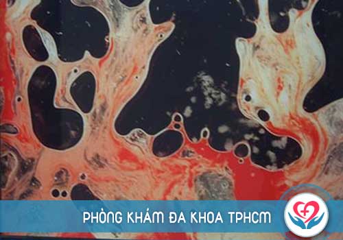 Tình trạng bệnh ảnh hưởng đến chi phí điều trị xuất tinh ra máu