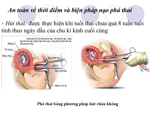 phá thai hút chân không