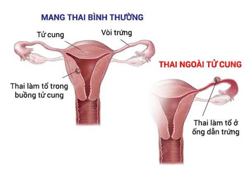 phá thai ngoài tử cung bằng thuốc