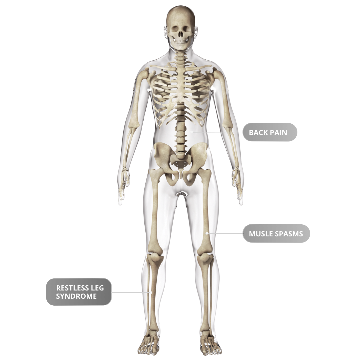 A 3D skeleton with labels showing symptoms