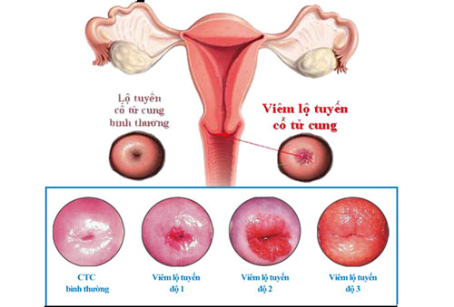 hình ảnh viêm lộ tuyến cổ tử cung qua 3 cấp độ