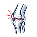 Advanced Knee Arthritis