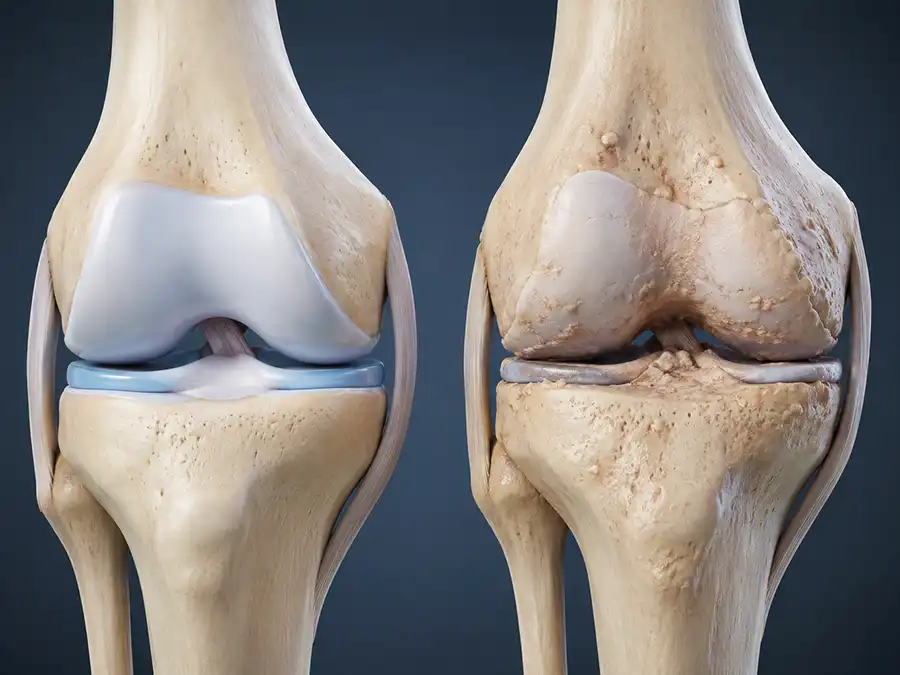 knee arthritis