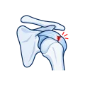 Illustration of a rotator cuff tendon tear.