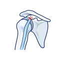 Illustration of the biceps tendon near the shoulder.