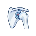 Illustration of a loose fragment within the shoulder joint.