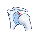 Illustration of an injured shoulder labrum.