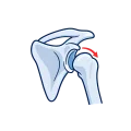 Illustration of shoulder joint instability.