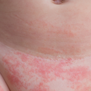 Hăm Tã Ở Trẻ Sơ Sinh: Dấu Hiệu, Triệu Chứng, Nguyên Nhân Và Cách Điều – Mustela Vietnam
