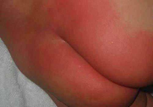 Hình ảnh bé bị hăm tã ở khu vực hậu môn, lỗ đít
