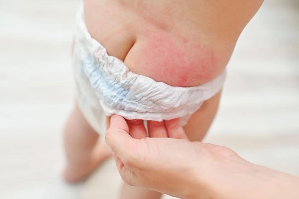 Có nên cho trẻ mặc tã khi bị hăm không? Hướng dẫn phòng ngừa và xử lý hăm  nhanh chóng cho mẹ