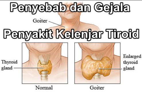 Cara Mengobati Kelenjar Tiroid Sampai Sembuh Total