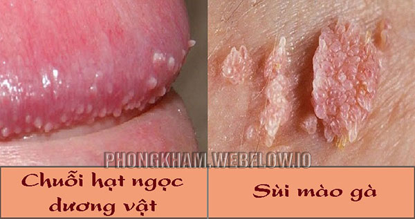 Bao quy đầu nổi mụn thịt do bệnh sùi mào gà