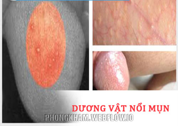 Bao quy đầu nổi mụn trắng, đỏ nguyên nhân cách xử lý