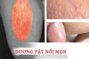 Dương vật nổi mụn trắng, đỏ gây ngứa hình ảnh, cách chữa hiệu quả