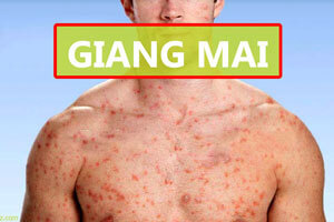 Bệnh giang mai là gì nguyên nhân triệu chứng cách điều trị hiệu quả nhất
