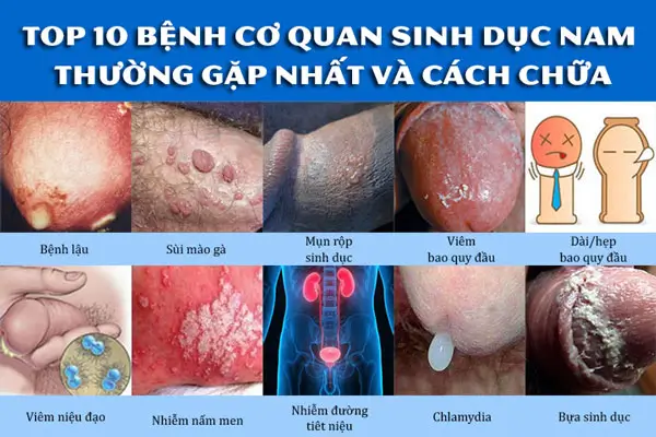 Tổng quan về bệnh cơ quan sinh dục nam